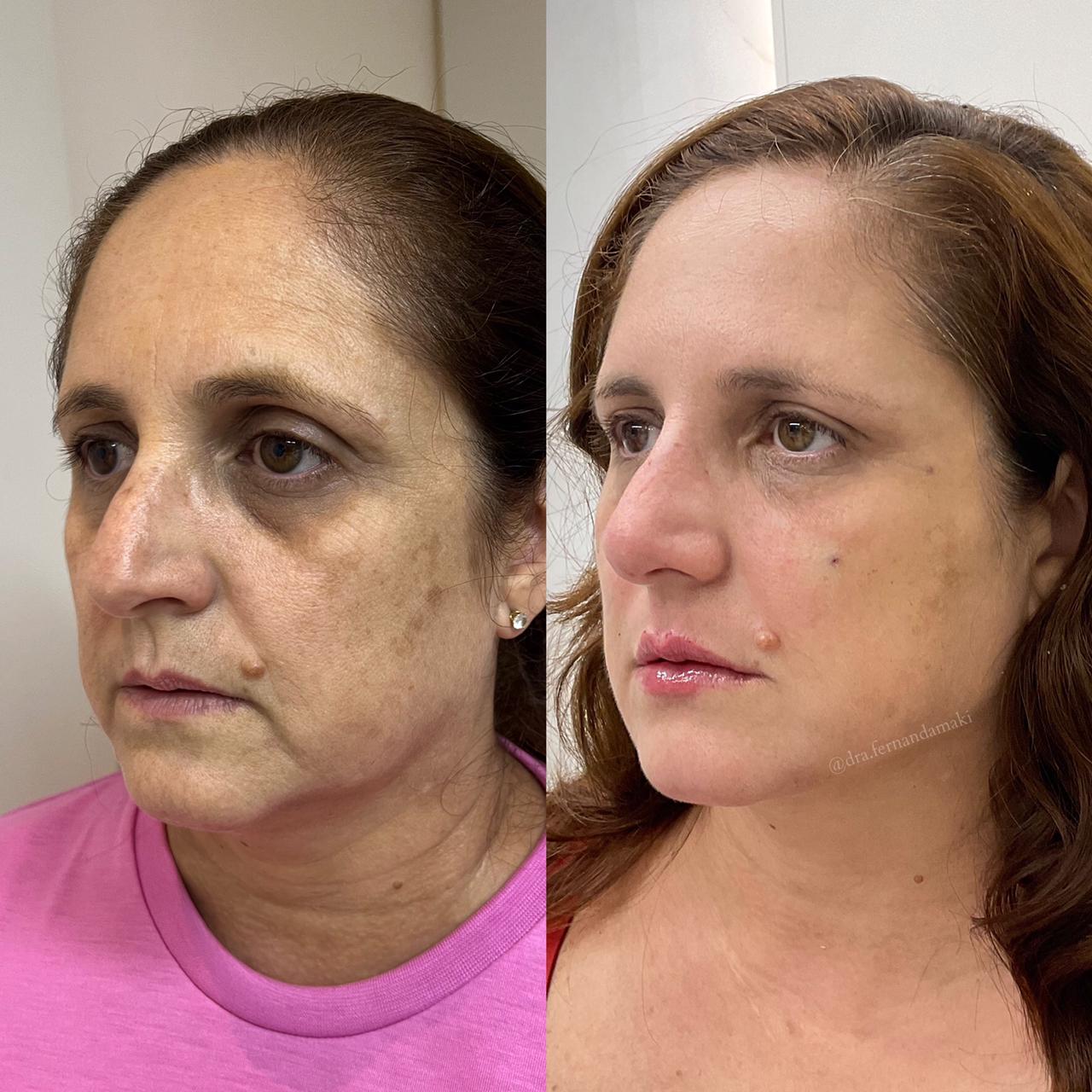 Antes e depois — Sustentação & Bioestimuladores