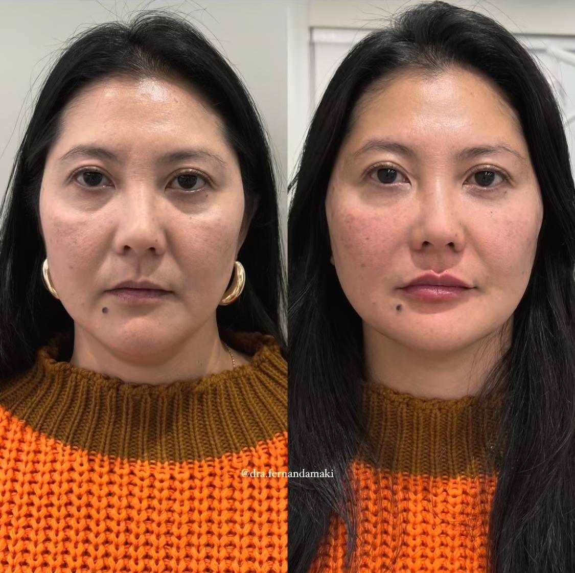 Antes e depois — Harmony UP®