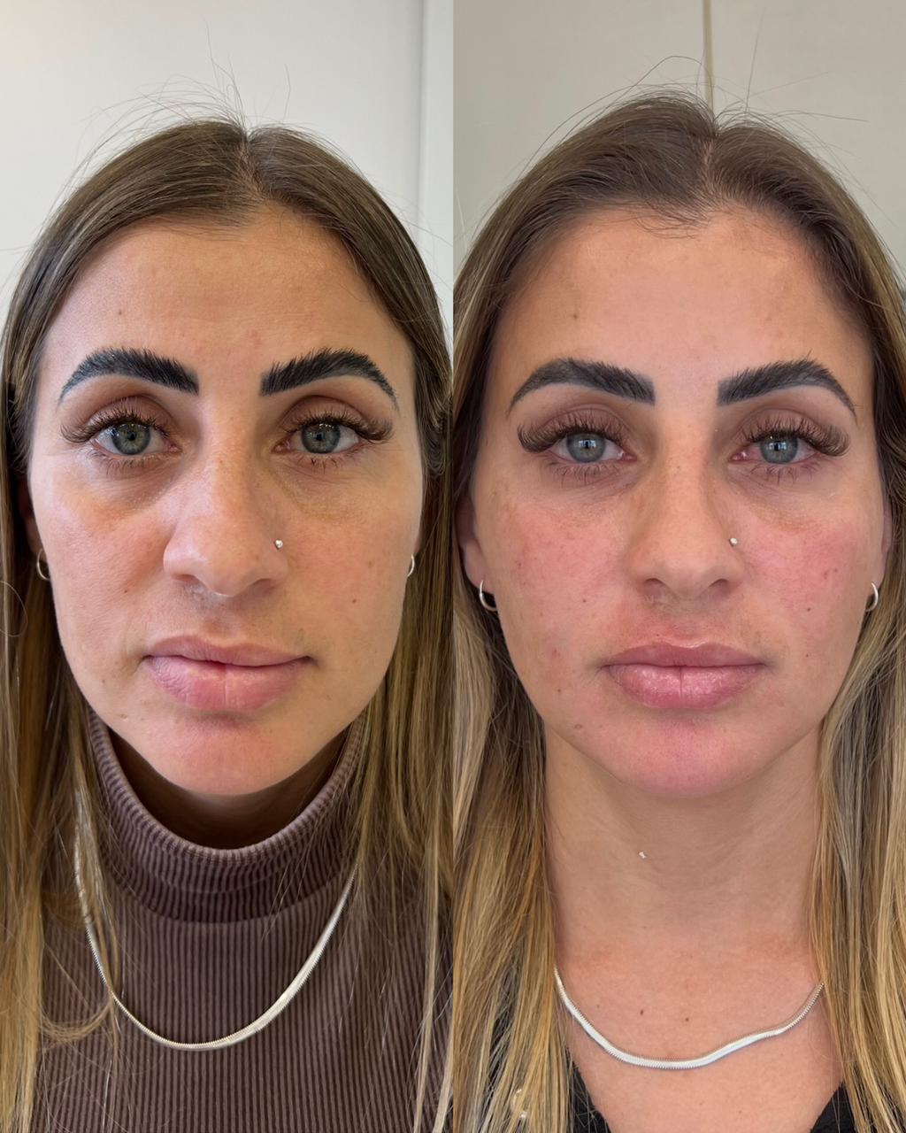 Antes e depois — Lifting Sem Cirurgia