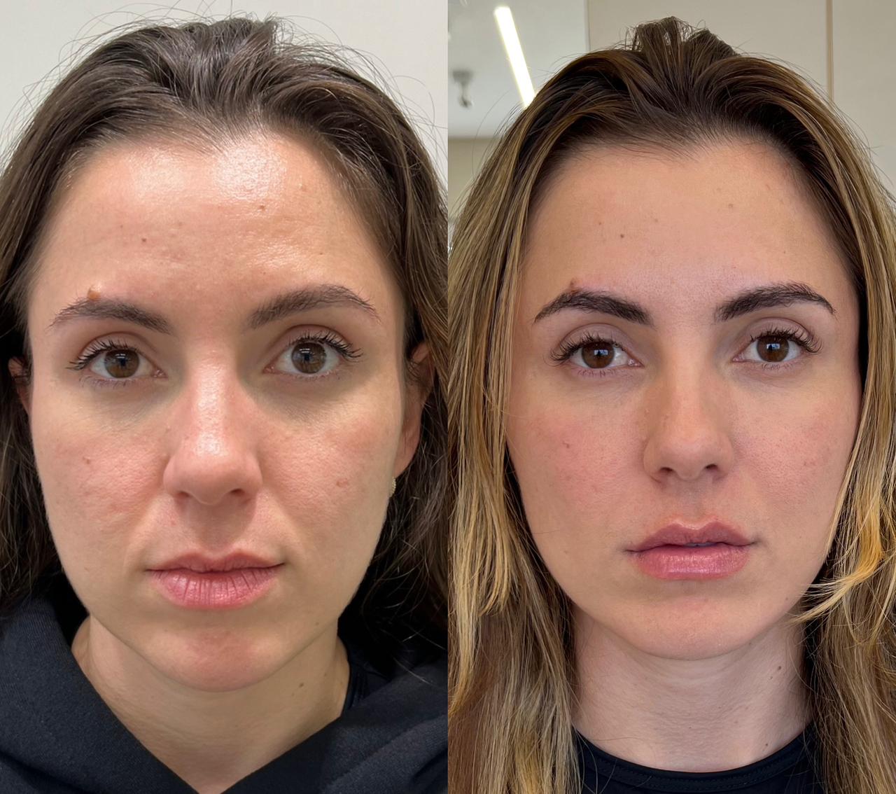Antes e depois — Harmony UP®
