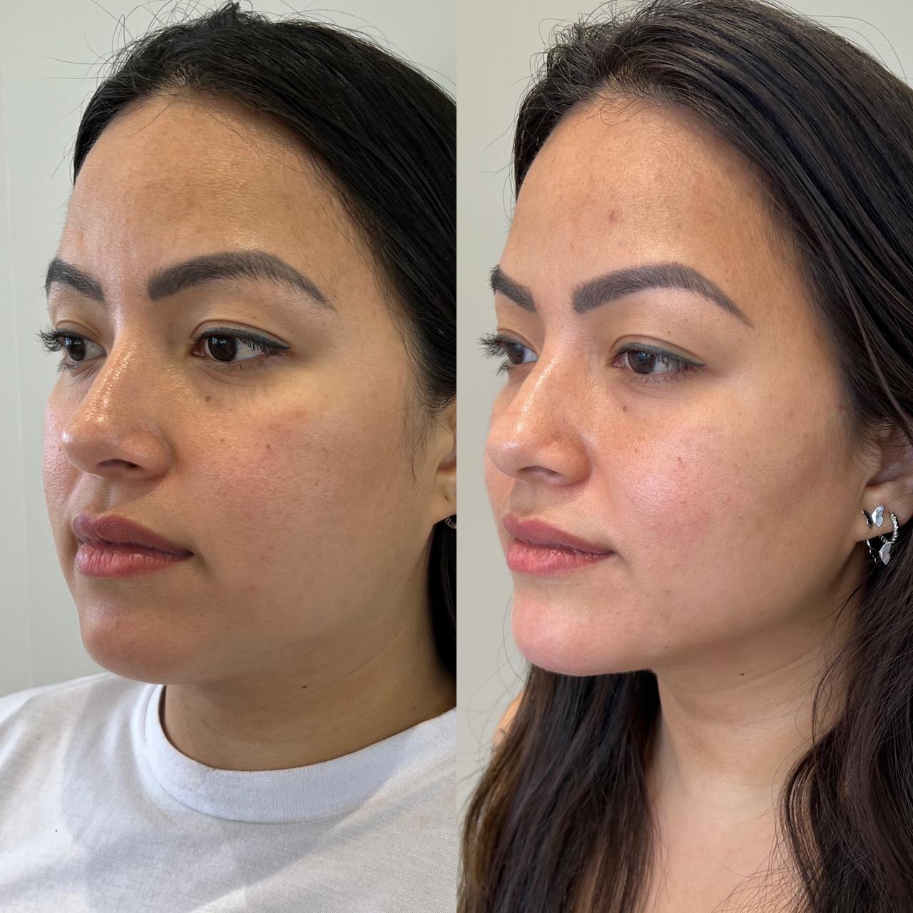 Antes e depois — Harmony UP®