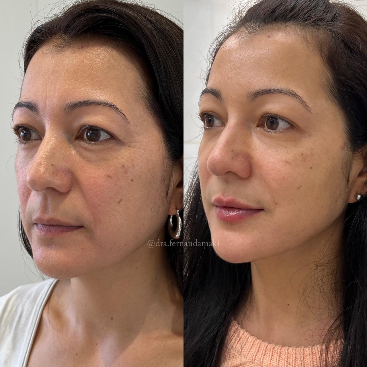 Antes e depois — Harmony UP®
