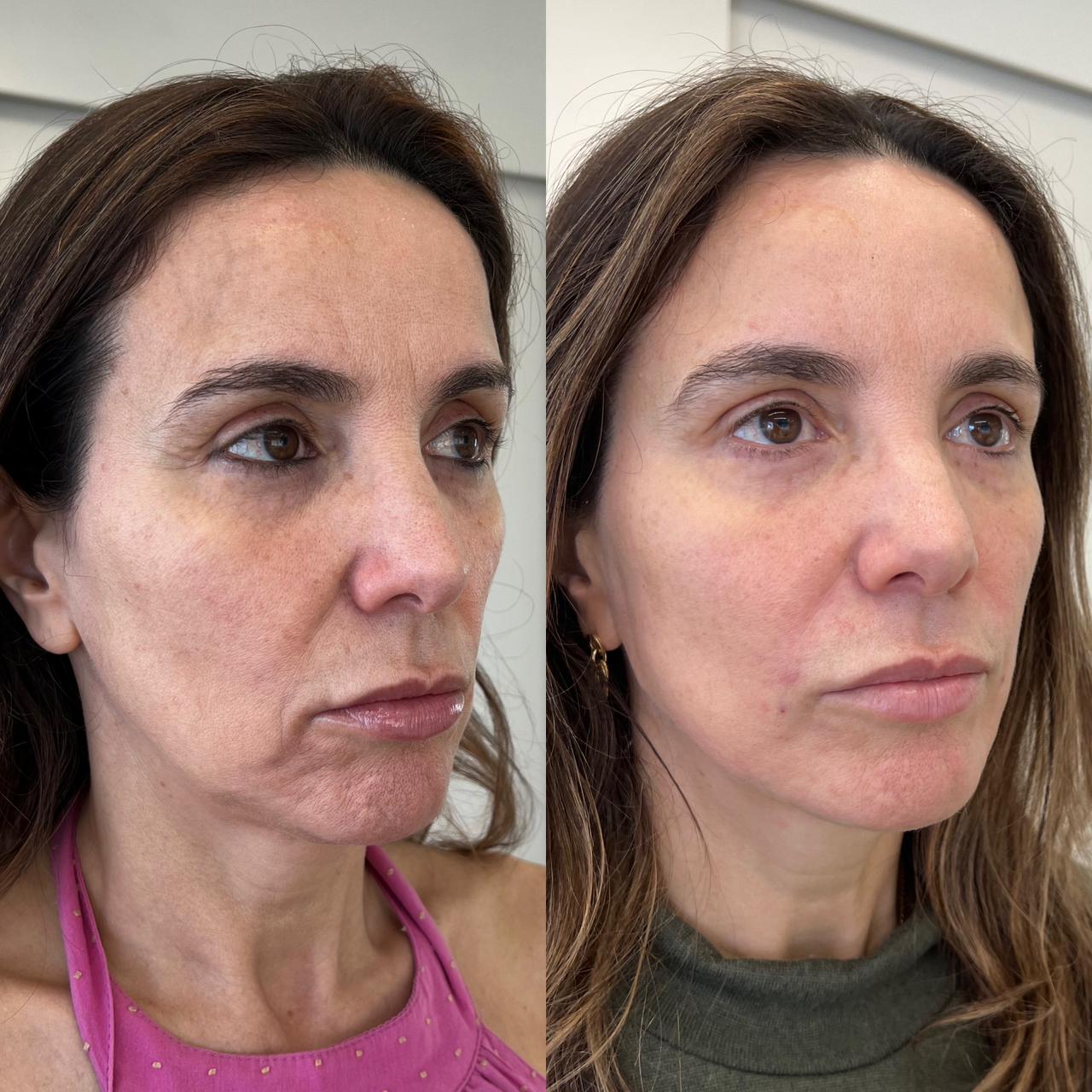 Antes e depois — Harmony UP®